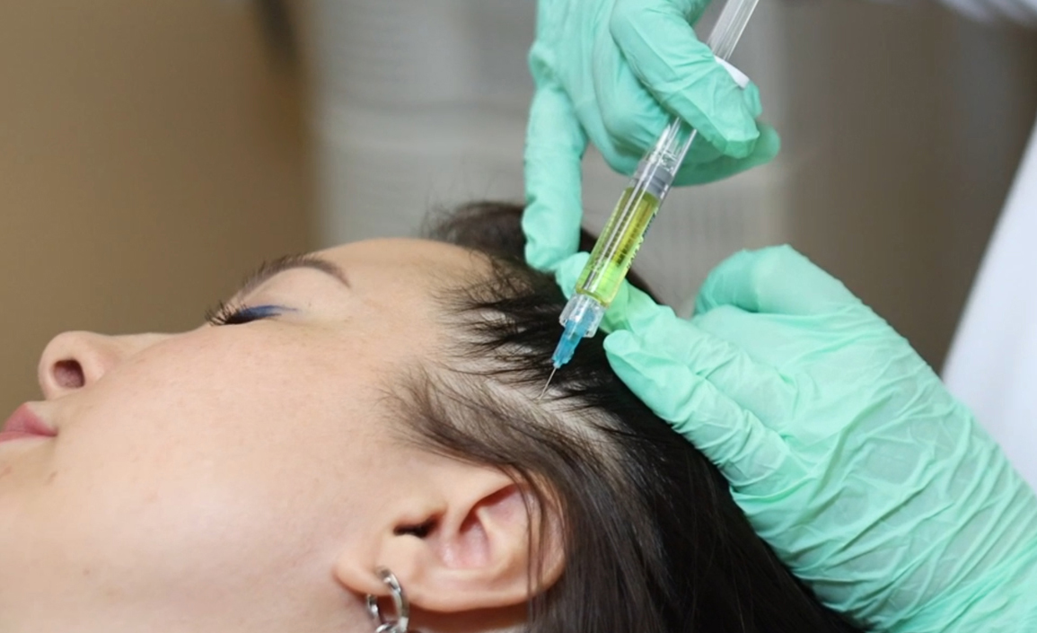 Мезотерапия