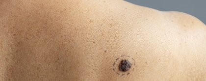 Удаление кератомы