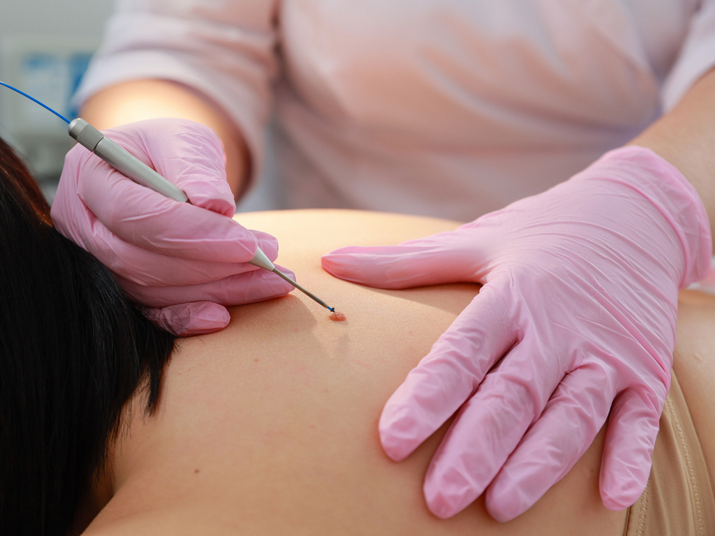 Удаление папиллом