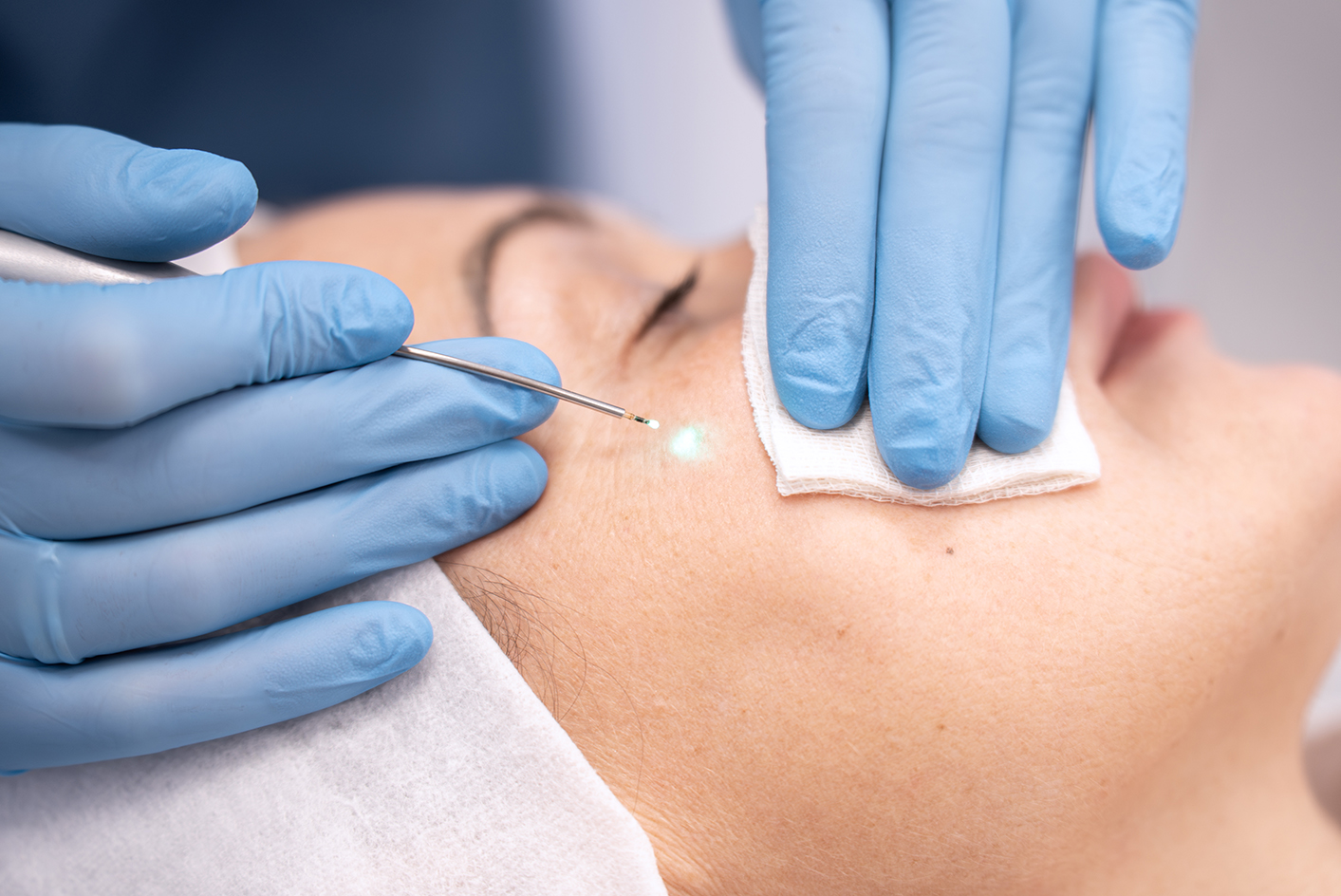 Удаление новообразований